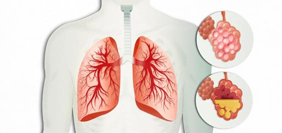 Пневмонія або запалення легенів: види, симптоми, лікування