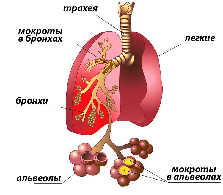 Пневмония (воспаление легких): симптомы, диагностика и лечение