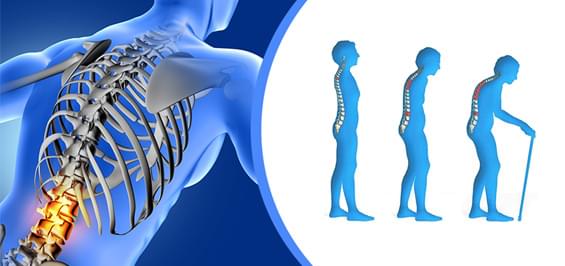 Зменшення міцності кісткової тканини: остеопороз