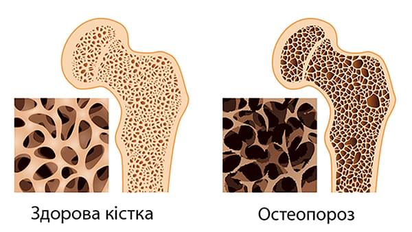 кістка з остеопорозом