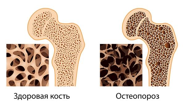 остеопороз кости