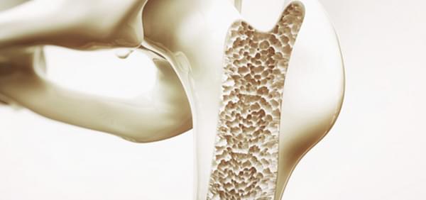 Уменьшение прочности костной ткани: остеопороз