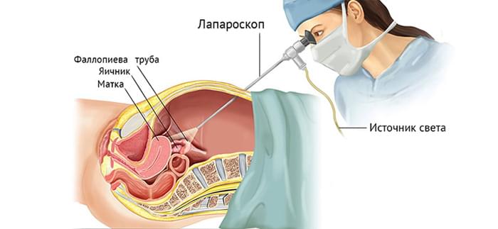 лапароскопия эндометрия