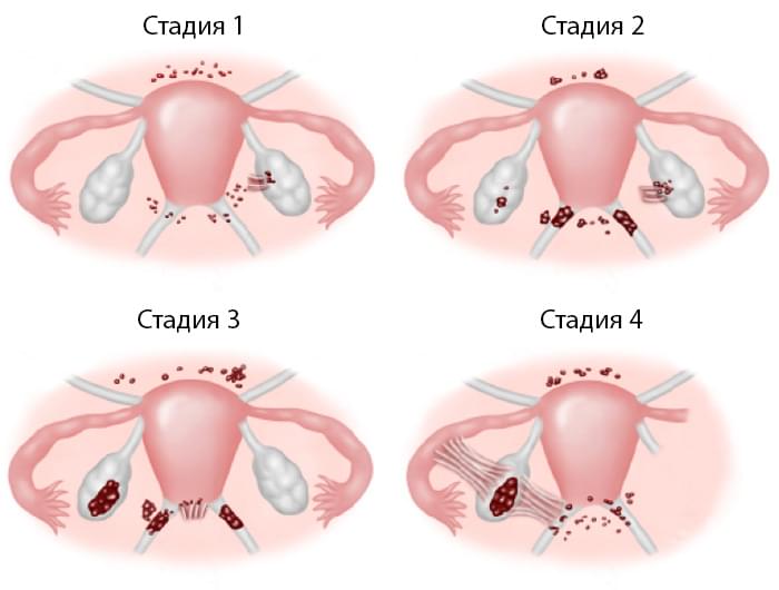 Эндометриоз - причины появления, симптомы заболевания, диагностика и способы лечения