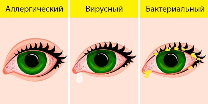 Признаки инфекционных заболеваний глаз