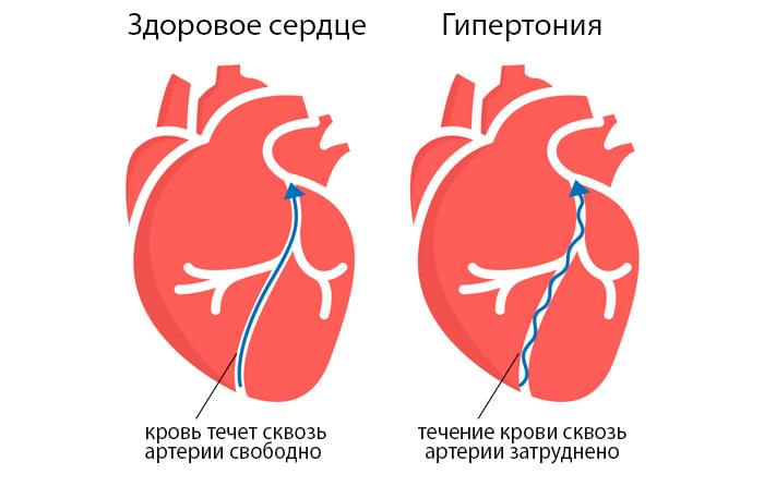 артериальная гипертензия