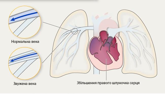 легенева артеріальна гіпертензія