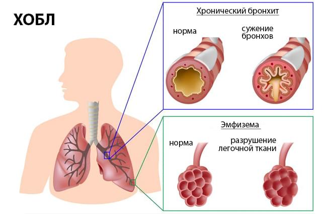 Заболевания лёгких и дыхательных путей
