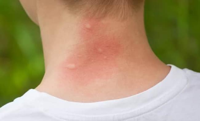 симптомы аллергии на насекомых