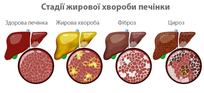 стадії жирової хвороби печінки