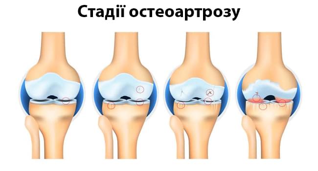 стадії остеоартрозу