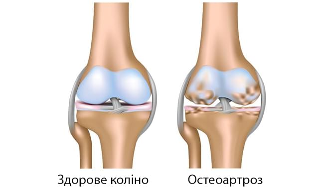 остеоартроз коліна