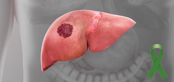 Симптомы рака печени: какая связь с циррозом?