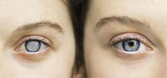 Как убрать синяк под глазом — советы как лечить синяк под глазом