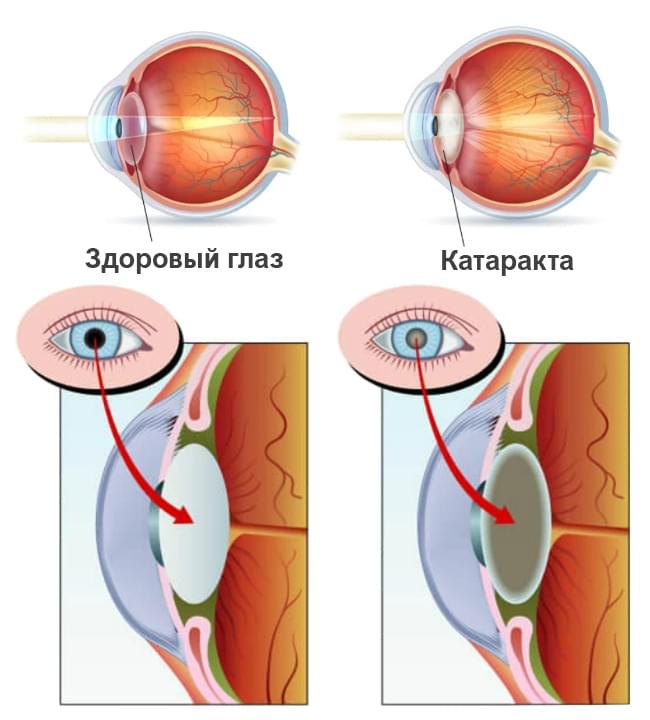 Почему боилт глаз после удаления катаракты?