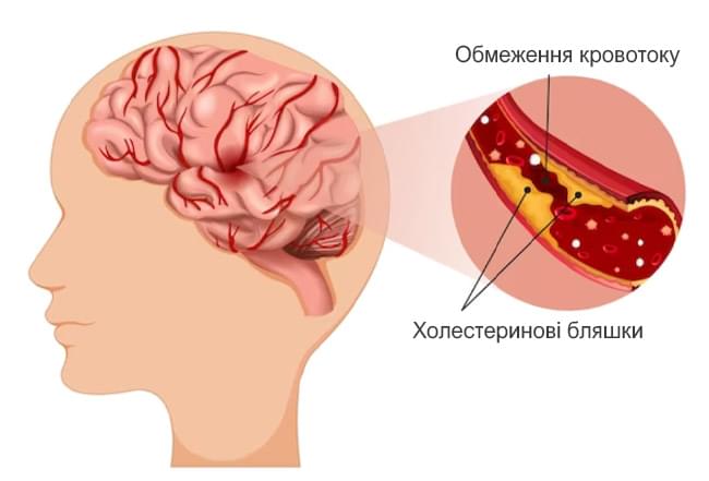 атеросклероз судин головного мозку