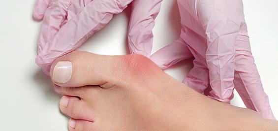 Профілактика і лікування бурситу великого пальця стопи