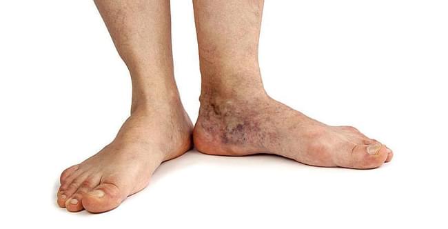 Трофическая язва на ноге: причины, симптомы и методы терапии