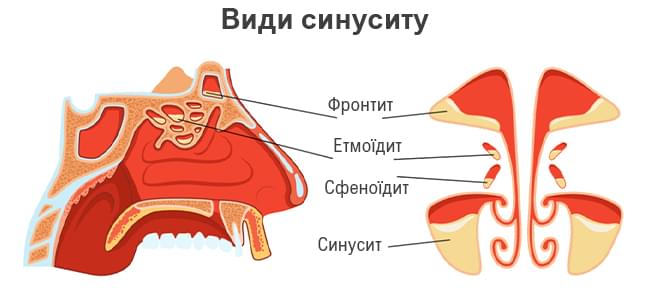 види синусита