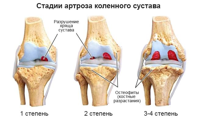 стадии артроза