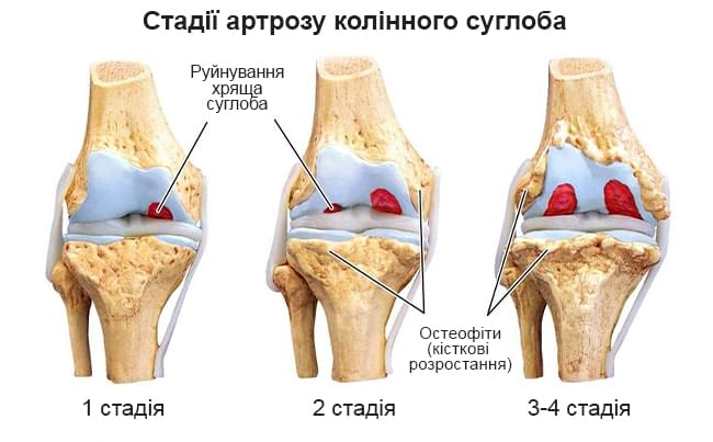 стадії артрозу