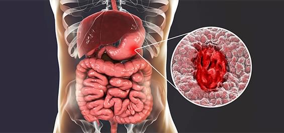 Виразка шлунка: що її викликає та як проявляється