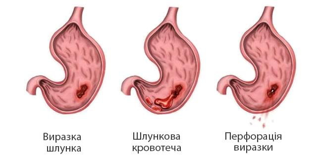 перфоррація виразки шлунку