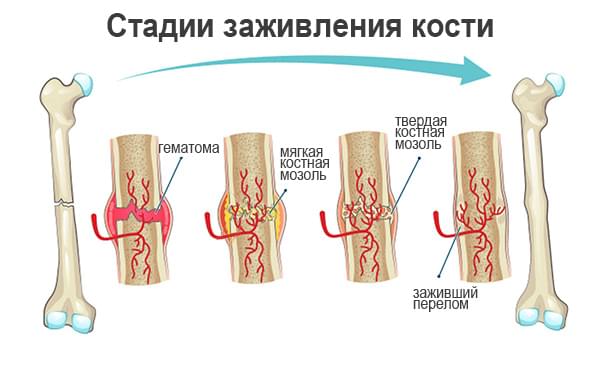 стадии заживления перелома