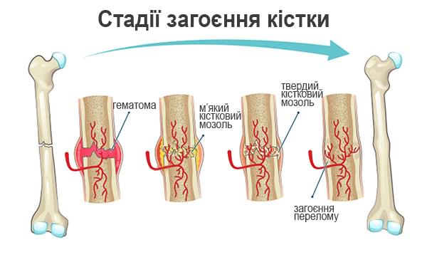 стадії загоєння перелому