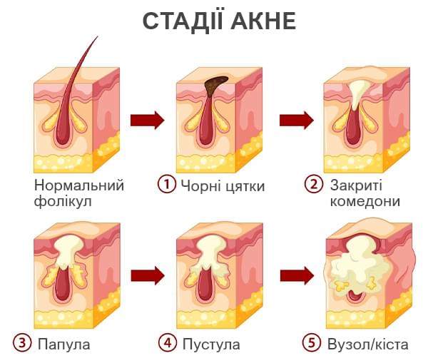 стадії акне