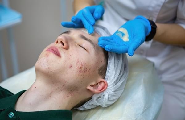 лікування акне