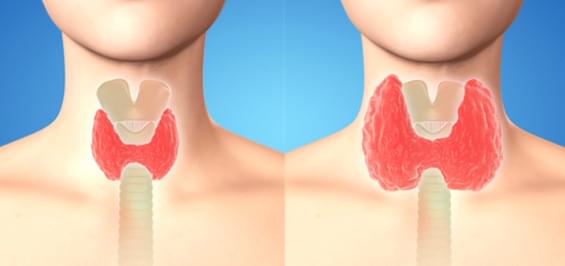Гіпертиреоз щитовидної залози: симптоми, лікування