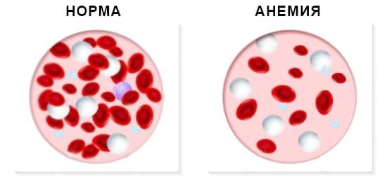 анемия гемоглобин