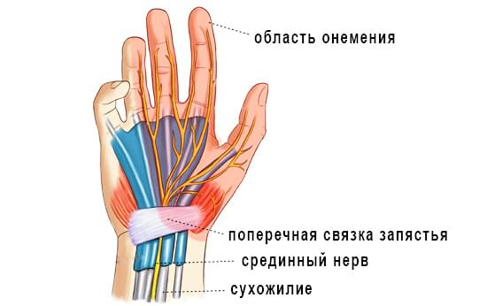 тунельний синдром руки