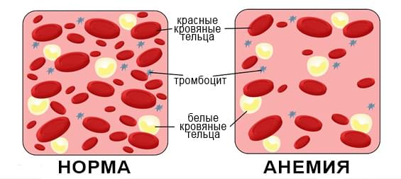 анемия гипоксия