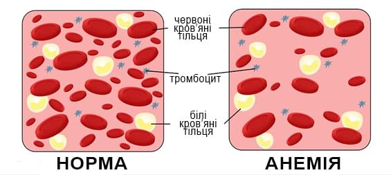 анемія гіпоксія