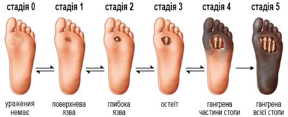 Синдром диабетической стопы