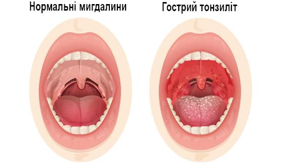 Лечение ангины, причины, виды заболевания, особенности клиники и жалоб — клиника «Добробут»