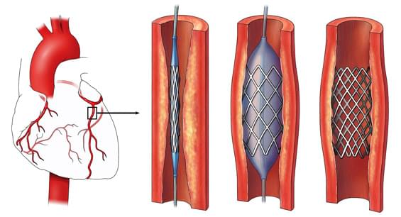 артериальное стенировние шунтирование