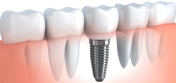 Незнімні види протезування зубів