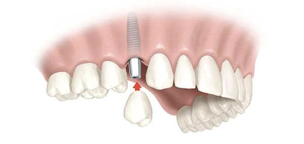 імплант зуба